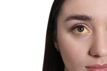 Woman with yellow eyes on white background, closeup. Symptom of hepatitis