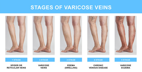 Stages of varicose veins. Collage with photos of woman showing changes during different phases,...