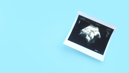 Prenatal ultrasound screening of unborn baby on blue background. Pregnancy concept. Copy space