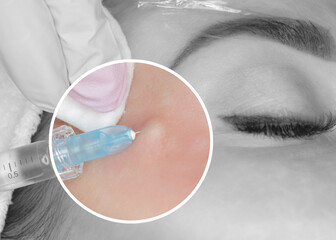 The cosmetologist makes the facial injections procedure for tightening and smoothing wrinkles on...