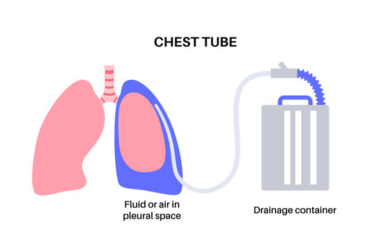 Chest tube catheter Generative AI