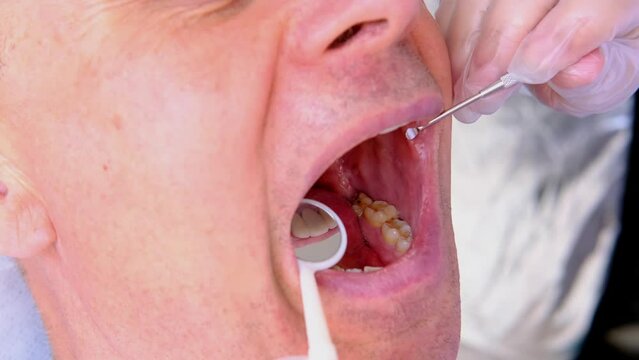 closeup female hands, dentist, doctor examines oral cavity of patient with tools, mirror, charismatic mature man 60 years old with open mouth, close up of mouth, tooth enamel is heavily worn