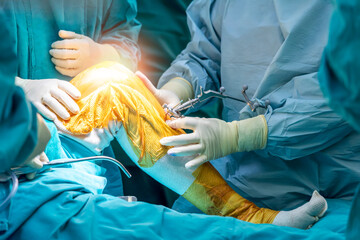 Doctor or surgeon in blue gown used robotic navigator total knee joint arthroplasty surgical...