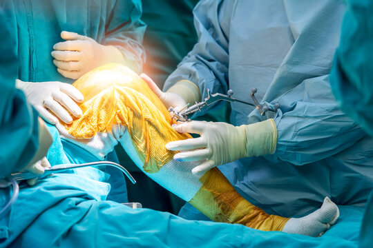 Doctor or surgeon in blue gown used robotic navigator total knee joint arthroplasty surgical instrument for surgery inside operating room.Medical technology in orthopedic surgery.Hand of people.