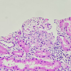 Cameras photo of segmental endocapillary hypercellularity in case of lupus nephritis, magnification...