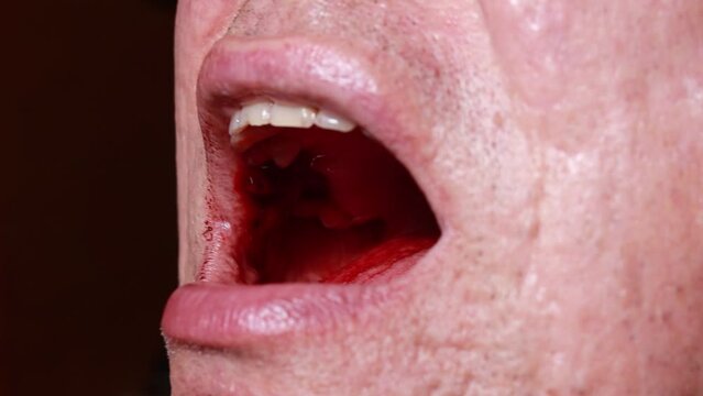 Close up man open mouth, jaw with teeth, detailed sealed bloody tooth after surgery in dental clinic. Tooth extraction treatment. Caries removing, nerve removal canals. Wisdom tooth, severe bleeding