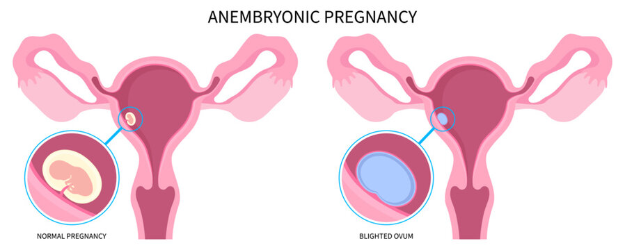 pregnancy loss missed abortion with Blighted ovum of anembryonic ectopic empty egg molar conception fertilization miscarriage and early first Natural