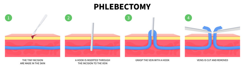 Phlebectomy Medical Anatomy of Vascular Artery Disease Varicose Vein Cramps Limb Injury or Endovenous Laser Venous and Valves Knee Heart Foot Calf Treat Flow Thigh Socks High Sores Aching