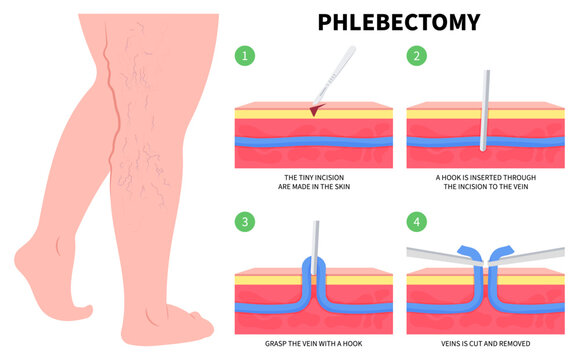 Limb Injury Phlebectomy Medical Anatomy of Vascular Artery Disease Varicose Vein Cramps or Endovenous Laser Venous and Valves Knee Heart Foot Calf Treat Flow Thigh Socks High Sores Aching