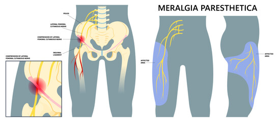 Leg Injury or Meralgia Paresthetica and IT Band Syndrome compressed spine tingling numbness pain thigh pinched nerve sciatica bursitis