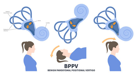 Semicircular Meniere’s Ear Canal Benign Paroxysmal Positional vertigo or BPPV loss balance dizzy Electronystagmography treat Canalith repositioning procedure otoconia calcium carbonate crystal brain - obrazy, fototapety, plakaty