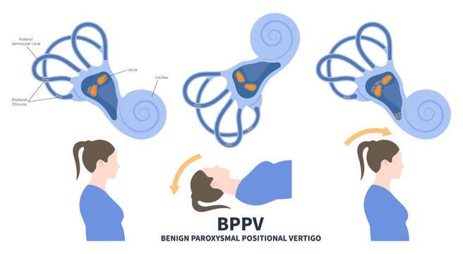 Semicircular Meniere&rsquo;s Ear Canal Benign Paroxysmal Positional vertigo or BPPV loss balance dizzy Electronystagmography treat Canalith repositioning procedure otoconia calcium carbonate crystal brain