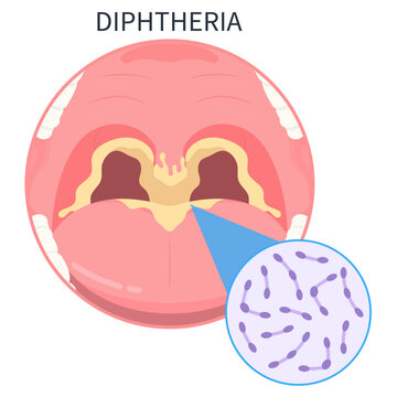Diphtheria vaccine of group A with the tetanus croup strep throat bacterial