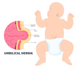 baby infant abdominal stomach pain umbilical hernia of inguinal incisional Femoral diastasis recti volvulus constipation intestine Hiatus birth belly button small large ileus lump navel wall cavity