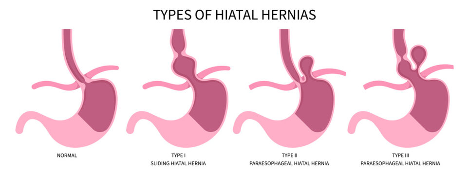 Hiatal Hernia Stomach Disease Heartburn bulges abdomen Nissen fundoplication acid gastroesophageal reflux Dysphagia Difficulty swallowing esophagitis abdominal treat Barrett&rsquo;s esophagus or GERD exam