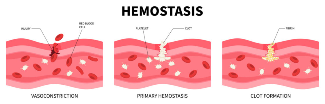 Hemostasis Hemophilia wound healing injury bleeding coagulation blood Fibrin platelet plug Thrombophilia formation fibrinolysis Cascade disorder red cell hemorrhage clot embolisms