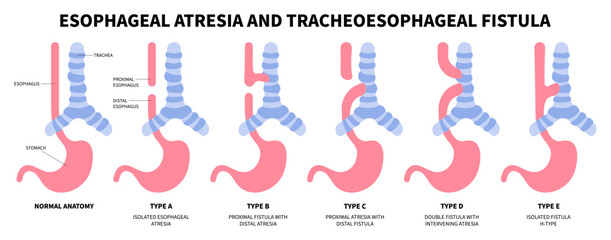 esophageal atresia tracheoesophageal fistula of baby and newborn infant pylorus disease pain - obrazy, fototapety, plakaty