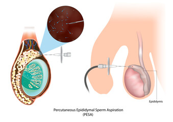 Percutaneous Epididymal Sperm Aspiration PESA. Testicular Biopsy. Epididymis. Azoospermia. Sperm retrieval techniques for azoospermic