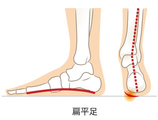 扁平足の側面と後ろ面
