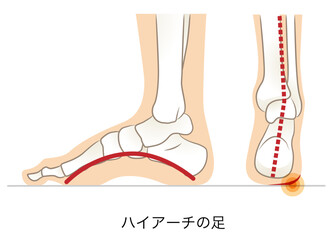 ハイアーチの足の側面と後ろ面