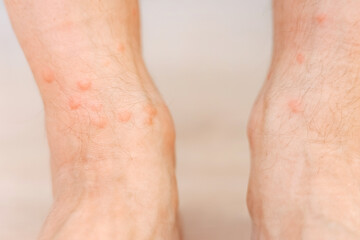 Close up allergic rash dermatitis eczema on man foot. Leg with red rash caused by insect bites. Dermatitis, folliculitis, fungal infection. Affected area of skin to turn red and blotchy and to swell