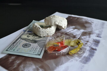 Plaster cast of teeth and dental plate on the background of money and dental x-ray. Dental...