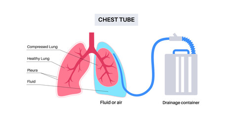 Chest tube catheter - 599439182