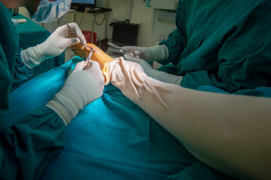 Hand of doctor or surgeon did foot surgery inside an operating room in the hospital.People in green gown used medical tools to suture the surgical wound.Foot and toe surgery of bunion.Light effect.