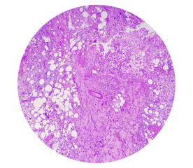 Photomicrograph of breast abscess, Granulomatous mastitis, show dense infiltration of polymorphs,...