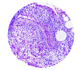 Photomicrograph of breast abscess, Granulomatous mastitis, show dense infiltration of polymorphs,...