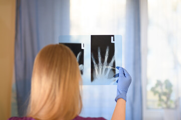 Fototapeta na wymiar Fizjoterapeutka trzymająca w dłoniach zdjęcie rentgenowskie złamanego palca dłoni 