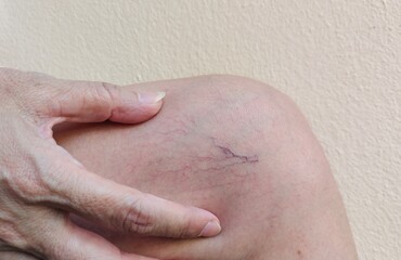 close up skin problem, the hands holding with varicose veins on the leg of woman, circulation of...