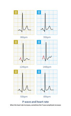 When the heart rate increases, sometimes the P wave amplitude increases.This is a physiological phenomenon, do not diagnose the right atrial abnormality.