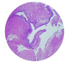 Histology of urachal cyst. Photomicrograph of histological stained slide showing Urachal cyst....