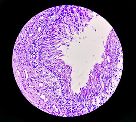 Histology of urachal cyst. Photomicrograph of histological stained slide showing Urachal cyst....