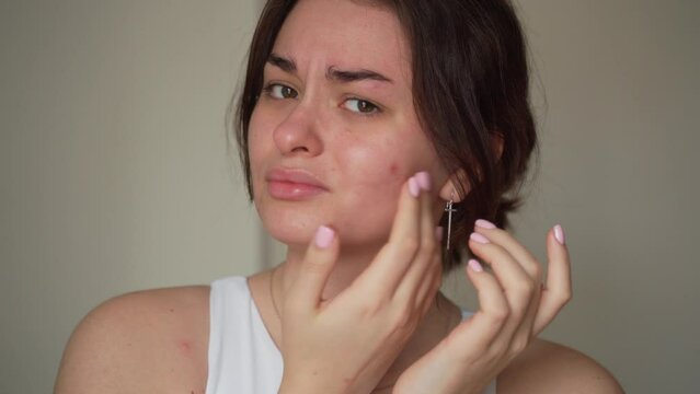 Young woman worried caused of acne inflammation and acne scar occur on her face. Teenage girl Inflamed acne consists of swelling, redness, and pores that are deeply clogged with bacteria, oil, and