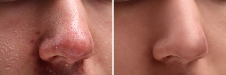Fototapeta premium Photos of man before and after acne treatment, closeup. Collage showing affected and healthy skin