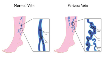 set of Varicose veins poster. Vector flat style cartoon varicose illustration isolated on white background. eps 10