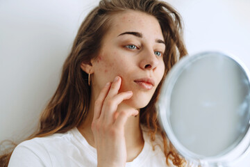 Young woman  with problem skin looking into mirror. Dermatology. Allergic reaction from cosmetic, red spot or rash on face.  Beauty care. 