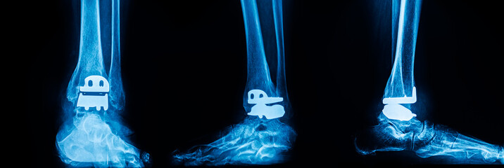 Blue radiograph on black background in hospital.Doctor used xray for diagnosis of patient.X-ray of total ankle joint arthroplasty with prosthesis.Orthopedic and radiology technology.Medical concept. - obrazy, fototapety, plakaty