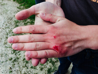 Cracked hands from the cold. Wounds on the climber's hands.
