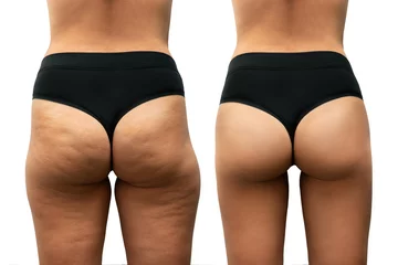Tuinposter Young tanned woman's thighs and buttocks with cellulite before and after treatment on white background. Getting rid of excess weight. Result of diet, sports, massage. Improving the skin on legs © Марина Демешко