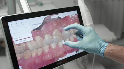 A professional dentist man looks at a 3d model of teeth on a computer monitor. Dental consultation, diagnostics. Jaw scan, digital imprint, medical digital technology - obrazy, fototapety, plakaty