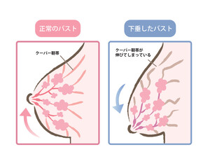 ハリのあるバストと垂れたバストのイラスト　ビフォアアフター