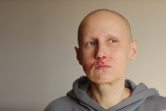 Hairless cancer sick female patient is bleeding from her nose, effects of chemotherapy. Young bald woman lost her eyebrows and eyelashes and has heavy nosebleed with red blood on the face.