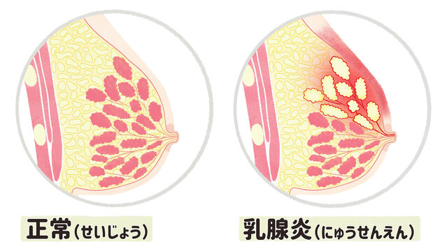 Normal breast and mastitis diagram; Japanese language PNG