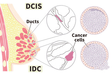 Anatomy of female breast cancer DCIS and IDC PNG