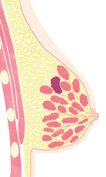 Anatomy of female breast cancer; lobular carcinoma PNG