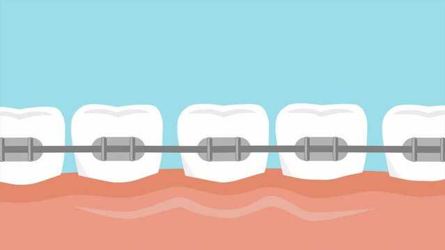 Teeth with braces alignment process. Medically accurate animation.