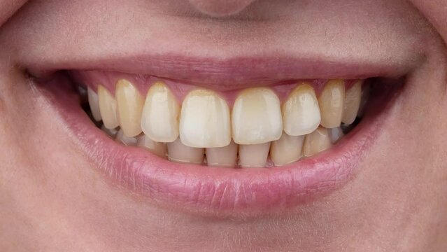 Close-up of a woman's smile. White teeth gradually turn yellow.